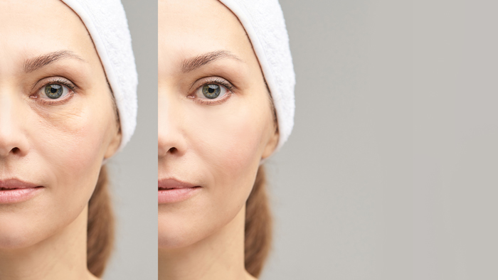 Before and after portrait. Anti wrincle healthy therapy. Black circle under eyes.