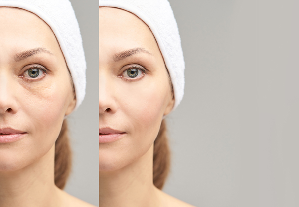 Before and after portrait. Anti wrincle healthy therapy. Black circle under eyes.